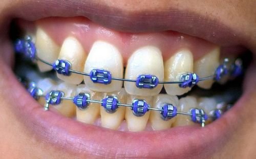 Braces-smile-purple