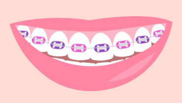 Best Colors For Braces