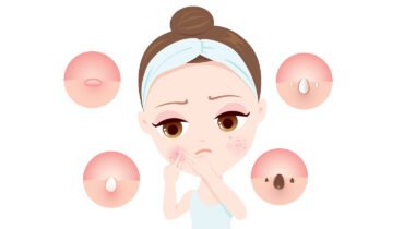 What Hormone Type Are You?